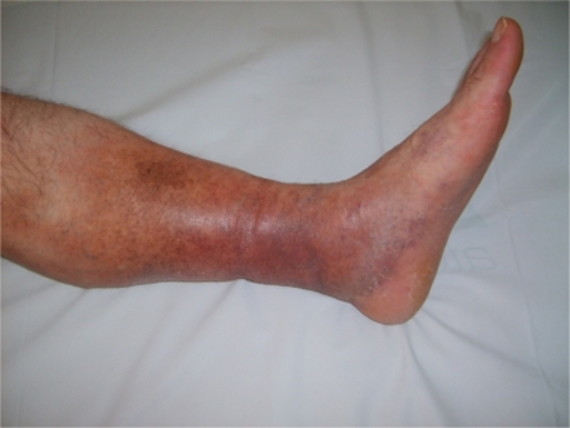 Superficial vein thrombosis or phlebitis