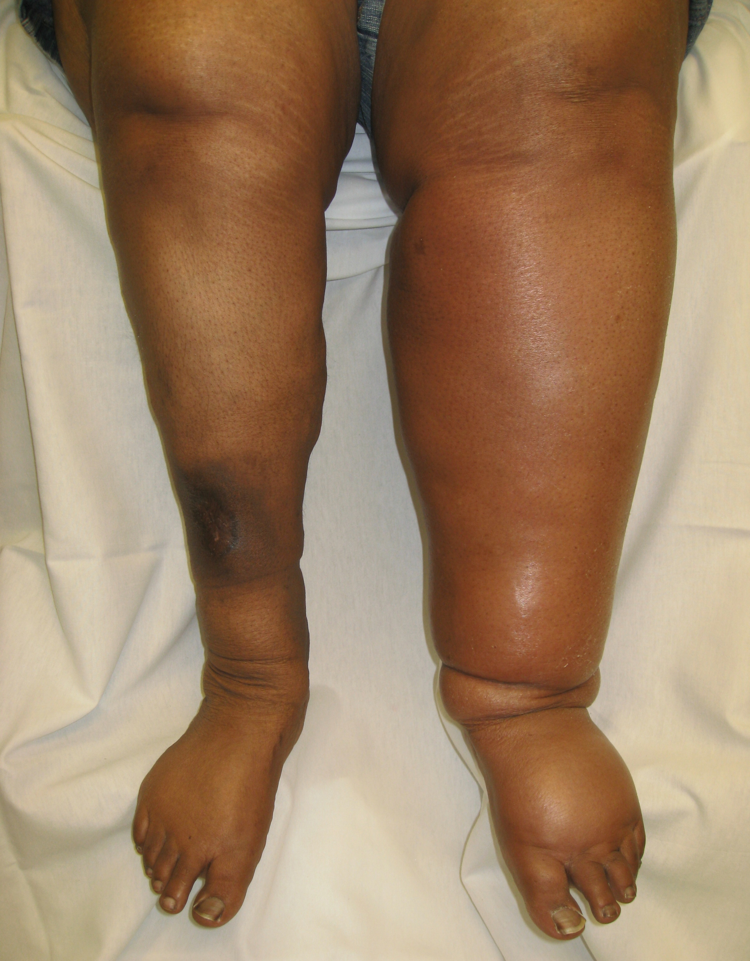 Lymphedema