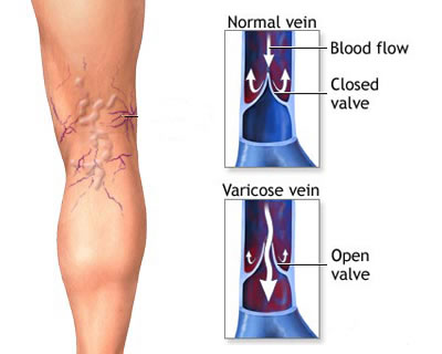 Causes, symptoms and consequences of varicose veins