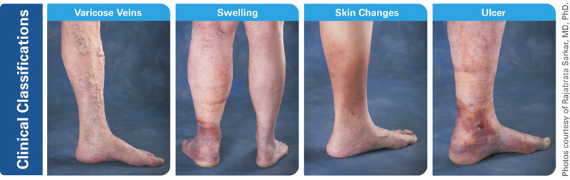 About Vein Disease