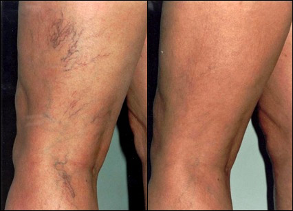 Spider Vein Treatment