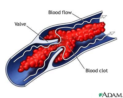 Potomac Spider Vein Expert: Treatment Benefits