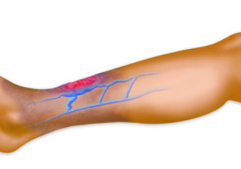 Vein Clinic in Rockville, MD: New Article