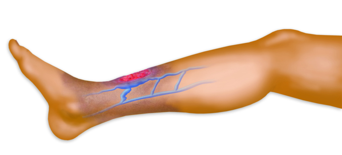 Vein Clinic in Rockville, MD: New Article