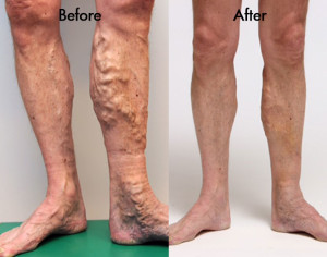 Varicose Vein Doctor in Rockville: Arterial vs. Vein Disease