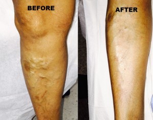 Varicose Veins