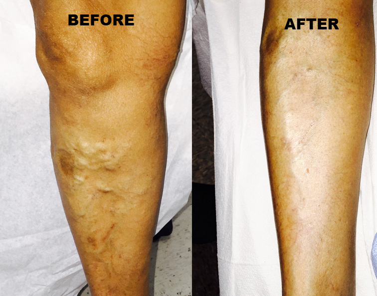 Washington DC Vein Specialist: Swelling & Health