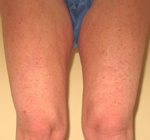 Spider Veins (After)