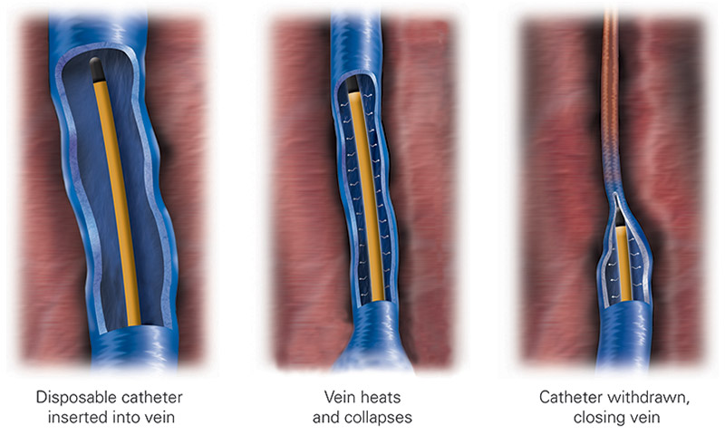 Top Vein Center in Rockville: Expert Guide to Swelling