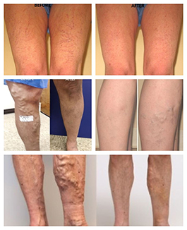 Varicose Vein Treatment, Medilaser Vein Center